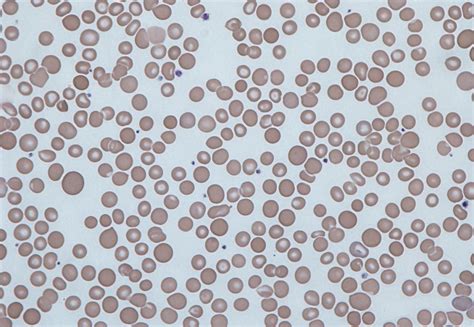 Anisocitose O Que É - Anisocitose: causas, sintomas e tratamento – Respostas Sempre Atualizadas