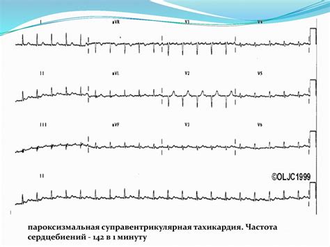 Тахиаритмия. Тахикардия - презентация онлайн