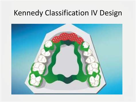 Designing A Removable Partial Denture Kennedys Classification