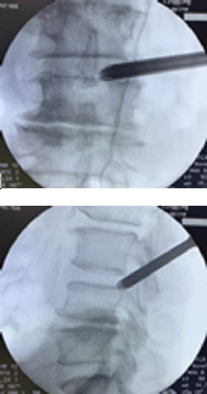 Figure From Linical E Cacy Of Percutaneous Endoscopic Lumbar