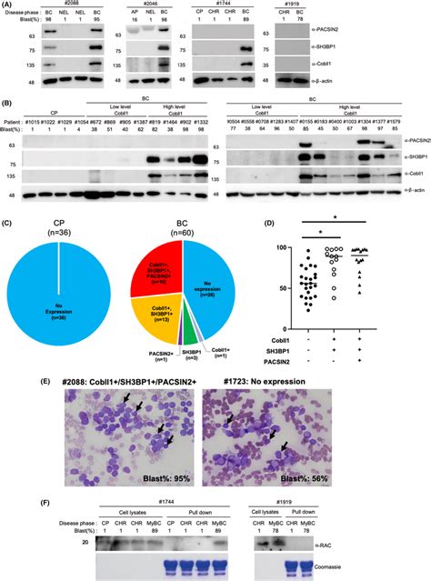 Clinical Correlation Of Cobll1 PACSIN2 SH3BP1 Expression In Patients