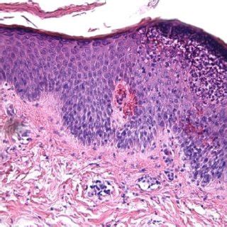 Spongiform Pustule Formation With Parakeratosis And Minimal Spongiosis