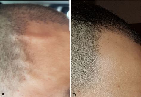 clinical appearance   subcutaneous serpiginous vessels april