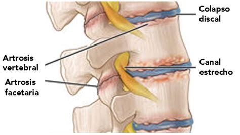 Artrosis facetaria causas síntomas y tratamientos Blog Clínica