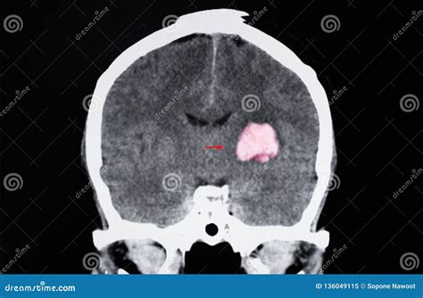 CT-Scan Brain Imaging For Hemorrhagic Stroke Or Ischemic Stroke Royalty ...