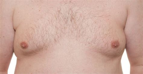 Common Causes Of Gynecomastia Dr Steven Warnock