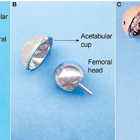 A typical prosthesis showing ball-and-socket joint regions where: (A ...