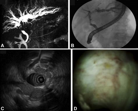 Obstructive Jaundice Caused By Postsplenectomy Cavernous Transformation