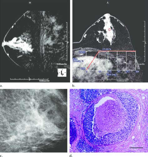 Comparison Of Mammographic And Mr Imaging Features Of Van Nuys Group 3