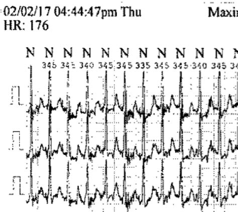 Atrial Fibrillation - Afib