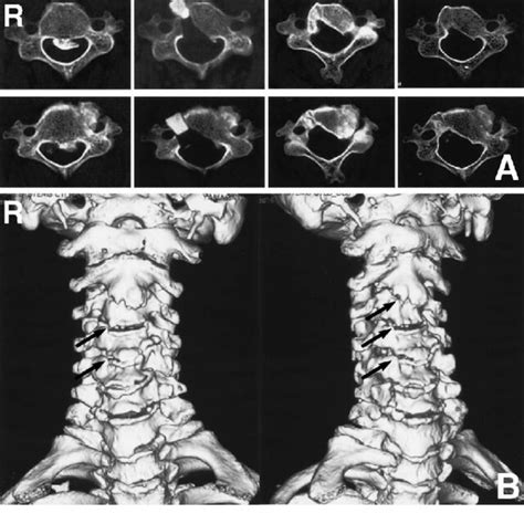 A 68 Year Old Man With Upper Cervical Ossification Of The Posterior