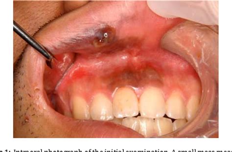 Figure 1 From Reconstruction Of An Upper Lip And Intraoral Defect