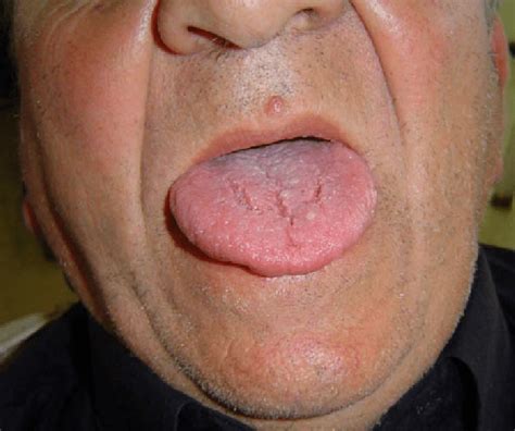 Collection Wallpaper Pictures Of Bumps On Tongue Full Hd K K