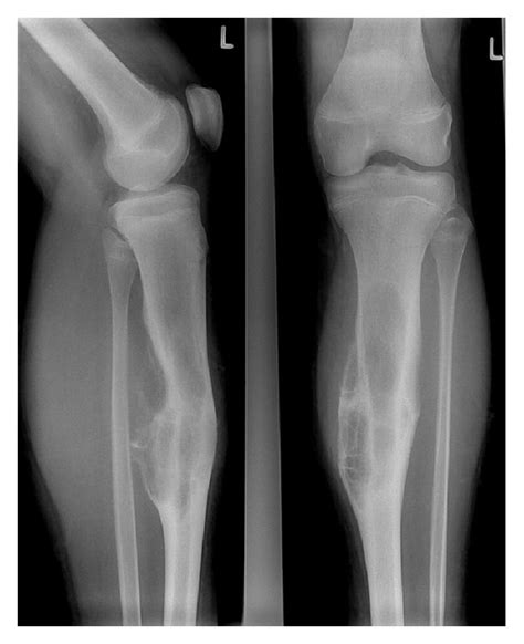 Patient No 9 A 14 Year Old Boy With Ewings Sarcoma Of The Left