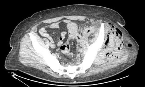 Computed Tomography Demonstrating Gas In The Left Gluteal Muscles And