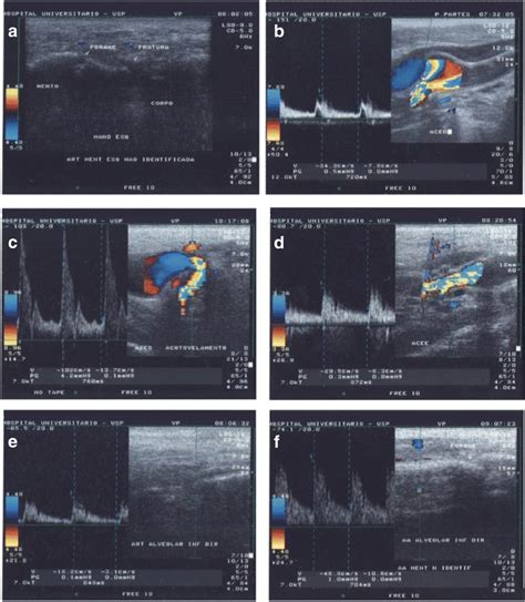 Doppler Sonography Examples And The Correspondent Spectral Curves Of Download Scientific