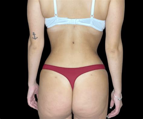 Lipoaspira O Caso Cl Nico J Ssica Sic Mymoment Cirurgia Pl Stica