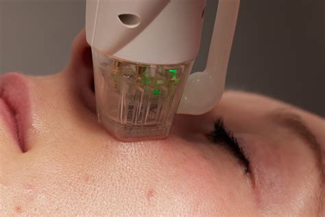 Radiofrequency Microneedling Rf