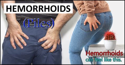 Hemorrhoids Causes Symptoms And Treatment Options Daddydontblog