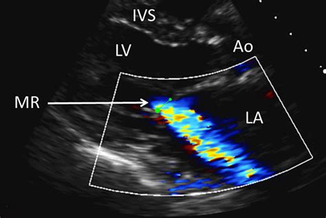 Mitral Valve Disease Clinical Review Gponline