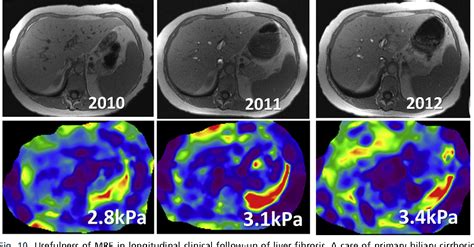 Magnetic Resonance Elastography Of Liver Semantic Scholar