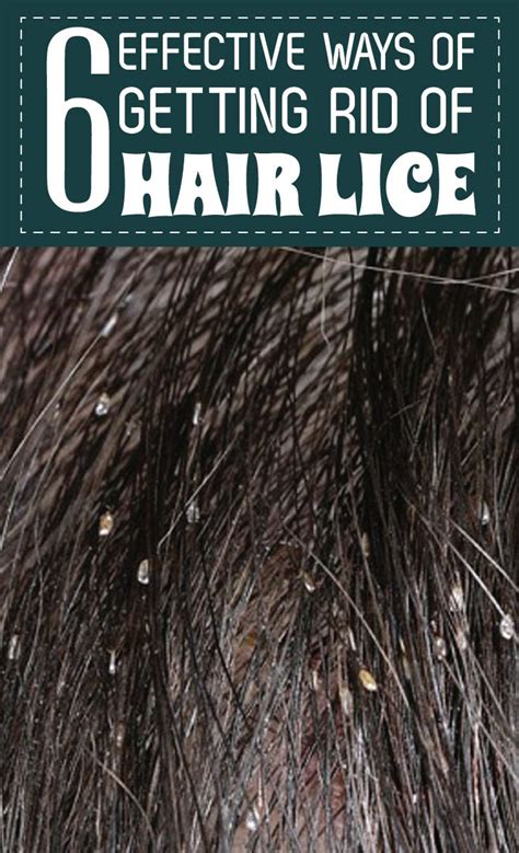 6 Effective Ways Of Getting Rid Of Hair Lice Hair Lice Lice Remedies Body Remedy