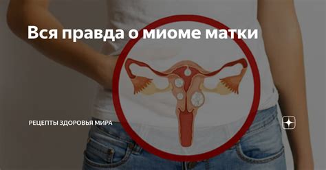 Вся правда о миоме матки | Рецепты здоровья мира | Дзен