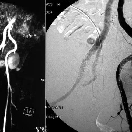 Left Arteriography Demonstrating Bilateral Iliac Pseudoaneurysm