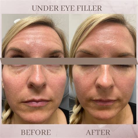 Under Eye Filler Eluma Laser Aesthetics