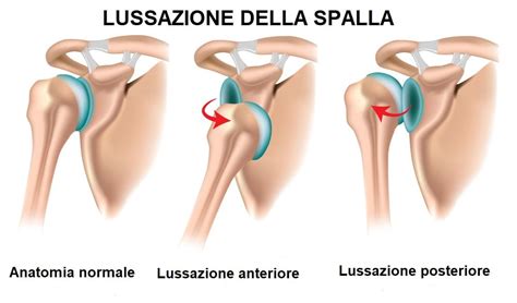 Lussazione Alla Spalla Sintomi E Rimedi