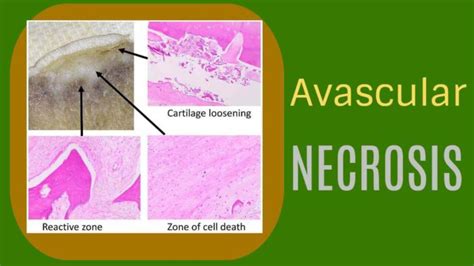 Avascular Necrosis: Definition, Symptoms, Risk Factors, Causes ...