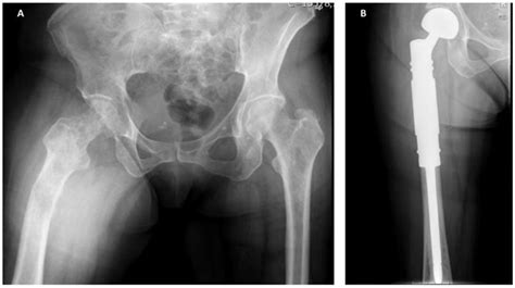 Extensive breast cancer bone metastasis in a female patient with ...