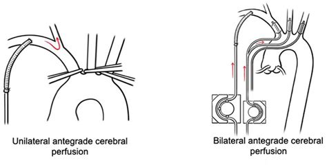 Uni Versus Bilateral Antegrade Cerebral Perfusion During Repair Of