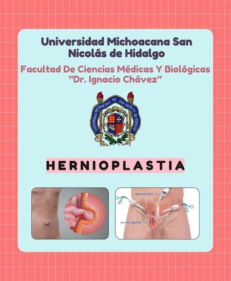 Hernioplastia Javier Rios Udocz