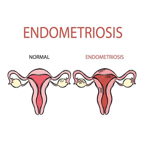 Premium Vector | ENDOMETRIOSIS NORMAL FEMALE Reproductive System Education