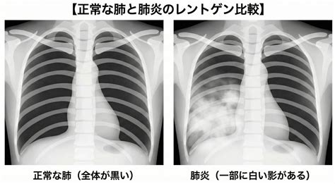 胸部レントゲン：肺炎は「白く」写るのに、なぜ気管支炎は「異常なし」なの？ ｜ よくあるご質問｜ましもと内科呼吸器科