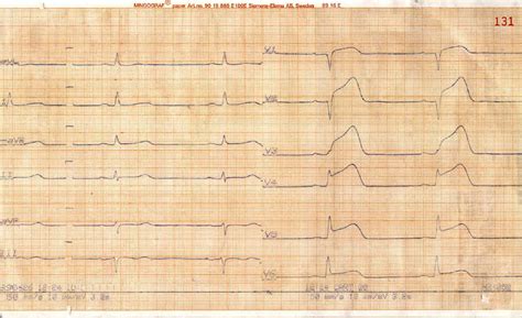 EKG Atlas Infarkt