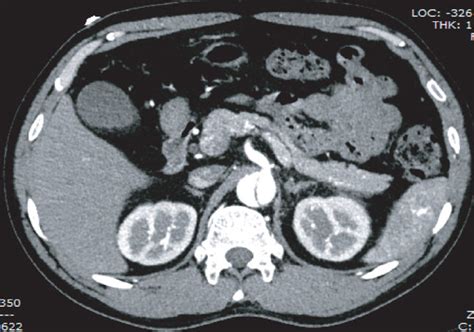 A Ct Angiography Scan Revealed Double Lumen Aortic Arch Structure