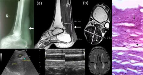 Cerebrotendinous Xanthomatosis The Spectrum Of Imaging Findings Pudhiavan Journal Of