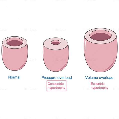 Ventricular hypertrophy vector