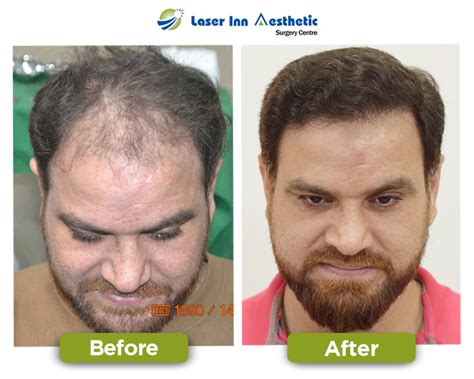 Laser Inn Best Hair Transplant Results Best Fue Hair Transplant