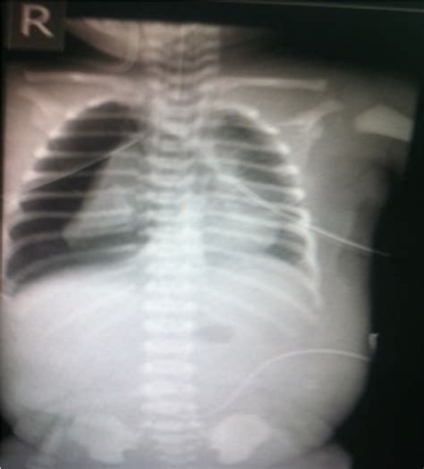 Figure From Congenital Neonatal Chylothorax With Hydrops Fetalis