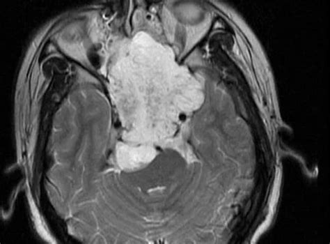 Chordoma Treatment | Department of Neurosurgery | IBS Hospital