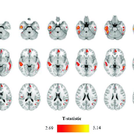 Increases In Resting Regional Cerebral Blood Flow RCBF In The Brain