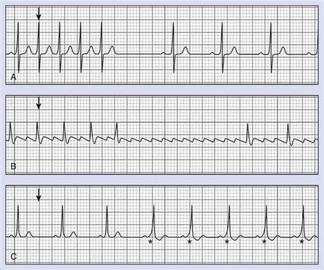 Provocative Testing For Arrhythmias Clinical Gate