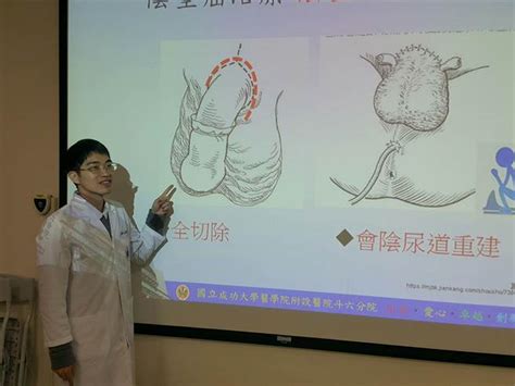 包皮過長演變為陰莖癌 醫師：長到不易清洗才需要割 健康 中時