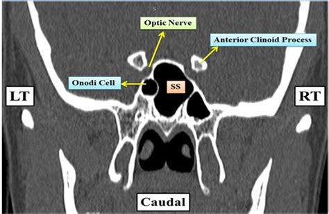 Optic Nerve And Sphenoid