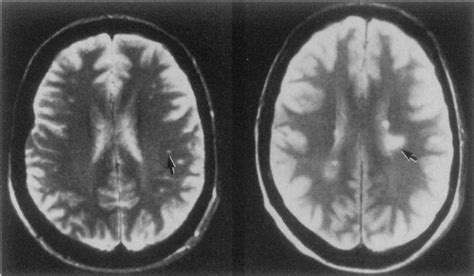 Chronic Neurologic Manifestations Of Lyme Disease Nejm