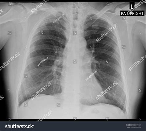 Plain Radiography Human Thorax Show Traumatic Stock Photo 1829979581