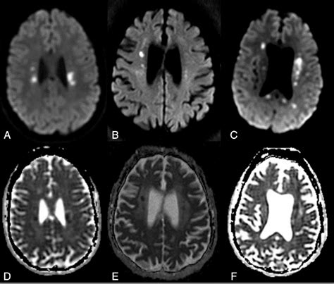 Figure 1 From Adult Onset Leukoencephalopathy With Axonal Spheroids And